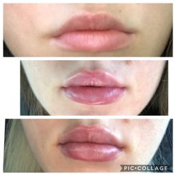 Before, first visit/syringe with swelling, and second visit/syringe with swelling. Laura is amazing! Before, first visit/syringe with swelling, and second visit/syringe with swelling. Laura is amazing!