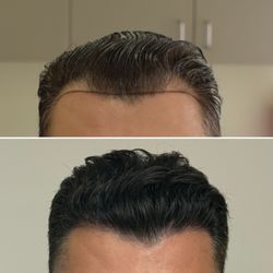 6 months post FUE Hair Restoration at only 50% density. Double density still to come next 10 months. Call for your free consultation.