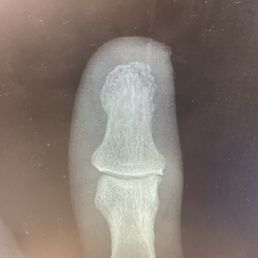 X-ray of fracture X-ray of fracture