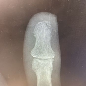 Tze C. Ip, MD - X-ray of fracture - Orthopedists Near Me - Newport Beach, California Tze C. Ip, MD - X-ray of fracture - Orthopedists Near Me - Newport Beach, California