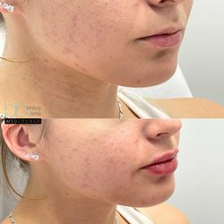 Beauty and Body Lounge - Lip augmentation with 1 syringe