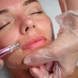 European Skincare & Acne Clinic - MicroNeedling European Skincare and Spa