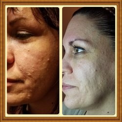 Face Time With Carolyne - Before and after chemical peels. No filters used.