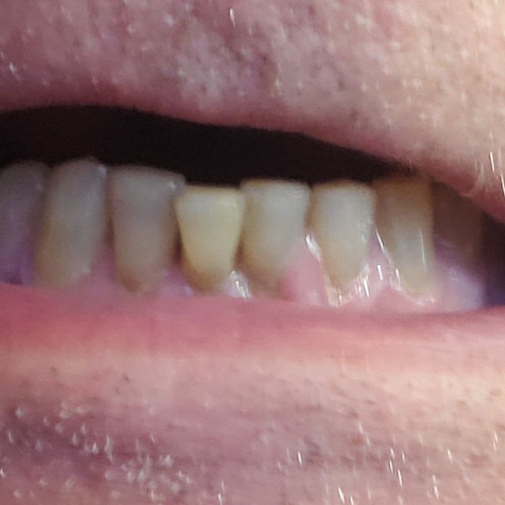 My existing teeth that were displaced because of poor placement of the broken tooth. My existing teeth that were displaced because of poor placement of the broken tooth.