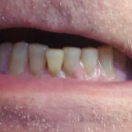 My existing teeth that were displaced because of poor placement of the broken tooth.