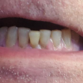 Stephen J Giovanisci, DDS - My existing teeth that were displaced because of poor placement of the broken tooth. - Orthodontists Near Me - Montrose, California