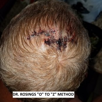 Allure MD - 3. Dr. Rosings miraculous fix!! - Plastic Surgeons Near Me - Newport Beach, California Allure MD - 3. Dr. Rosings miraculous fix!! - Plastic Surgeons Near Me - Newport Beach, California