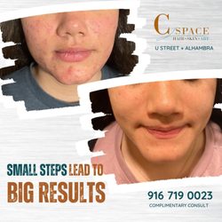 C Space Hair Skin & Art - We specialize in acne treatments! Let us help you find what works.