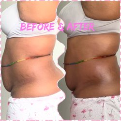 The Bawdy Beauty Bar - Ultrasonic cavitation treatment