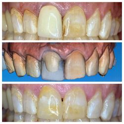 Nathaniel J Khoe, DDS - Natural look is in, no one needs to know you have a crowned front tooth.