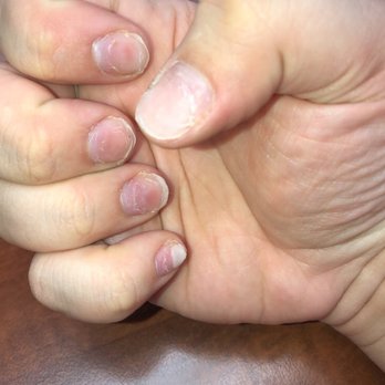 City Nails - Fungus on pinky nail - Nail Salons Near Me - Rockford, Illinois City Nails - Fungus on pinky nail - Nail Salons Near Me - Rockford, Illinois