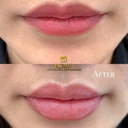 Phi MD Aesthetics - Lip filler