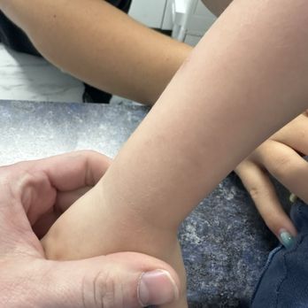 Kid City USA - Lee’s Summit - Bite after 2 weeks of healing - Child Care & Day Care Near Me - Lee's Summit, Missouri Kid City USA - Lee’s Summit - Bite after 2 weeks of healing - Child Care & Day Care Near Me - Lee's Summit, Missouri