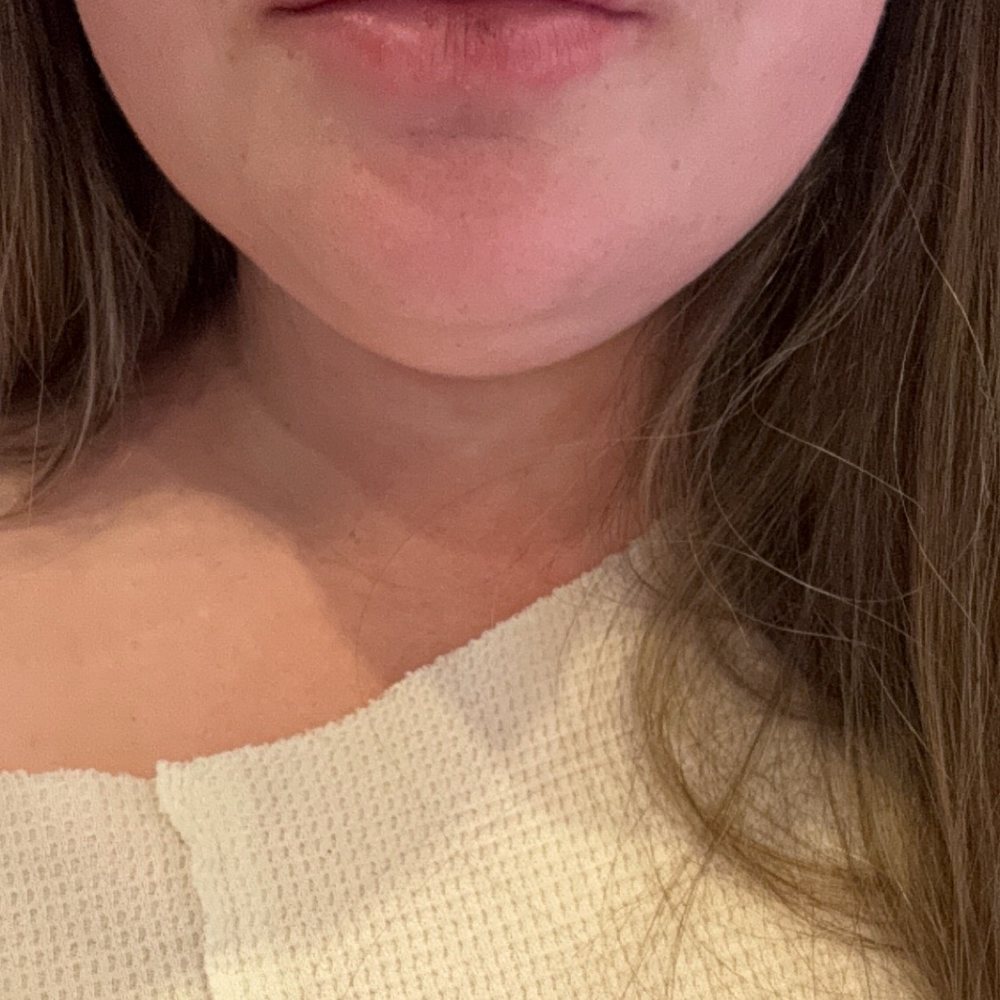 Desert Eyesthetics - After 1 syringe, 80% up top, 20% on bottom - Ophthalmologists Near Me - Gilbert, Arizona Desert Eyesthetics - After 1 syringe, 80% up top, 20% on bottom - Ophthalmologists Near Me - Gilbert, Arizona