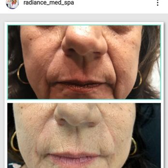 Radiance Medspa - Careful filler(restyle Lyft) placement to soften laugh lines and to create lifted cheeks! - Medical Spas Near Me - Weston, Florida Radiance Medspa - Careful filler(restyle Lyft) placement to soften laugh lines and to create lifted cheeks! - Medical Spas Near Me - Weston, Florida