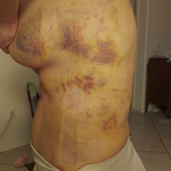 Elite Plastic Surgery - Burned my whole body felt like got burned by fire. Excruciating pain. - Cosmetic Surgeons Near Me - Phoenix, Arizona Elite Plastic Surgery - Burned my whole body felt like got burned by fire. Excruciating pain. - Cosmetic Surgeons Near Me - Phoenix, Arizona