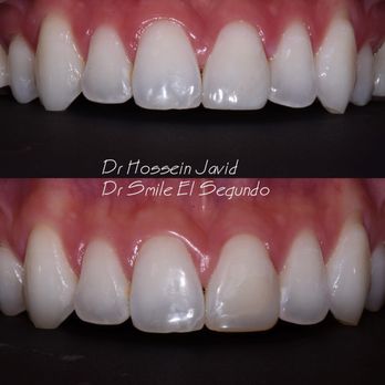 Toothopia Dental - Poorly done bonding on a ptient's front tooth was redone to perfection. Thank to Dr Javid and his another patient's confidence was restored. - General Dentistry Near Me - El Segundo, California Toothopia Dental - Poorly done bonding on a ptient's front tooth was redone to perfection. Thank to Dr Javid and his another patient's confidence was restored. - General Dentistry Near Me - El Segundo, California