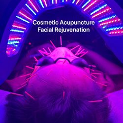 Dr. Han Acupuncture & MedSpa - Facial Acupuncture