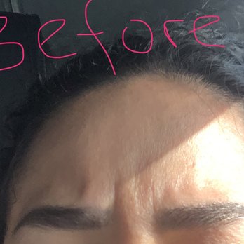 Shahin Javaheri, MD - before - Cosmetic Surgeons Near Me - Berkeley, California