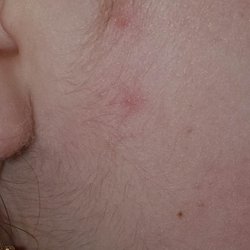 Re/Max Cove Mountain Realty & Cabin Rentals - BED BUG BITES