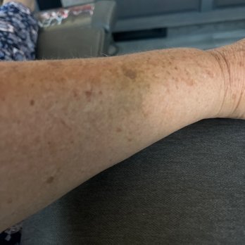 Stripes Primary Care - Bruising to forearm from 1 week ago. - Allergists Near Me - Apache Junction, Arizona Stripes Primary Care - Bruising to forearm from 1 week ago. - Allergists Near Me - Apache Junction, Arizona