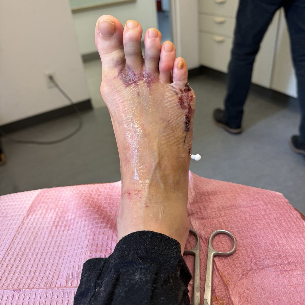 Manhattan Footcare - First bandage off. - Podiatrists Near Me - New York, New York Manhattan Footcare - First bandage off. - Podiatrists Near Me - New York, New York