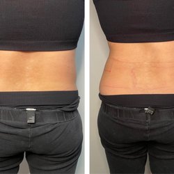Infinity Beauty & Body - Before on the left. After photos on the right! Amazing and pleased with my results
