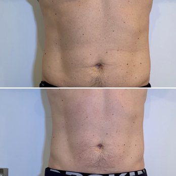 Precision Aesthetics - emsculpt six pack abs best price sterile luxurious boutique 212 799 1411 - Skin Care Near Me - New York, New York Precision Aesthetics - emsculpt six pack abs best price sterile luxurious boutique 212 799 1411 - Skin Care Near Me - New York, New York