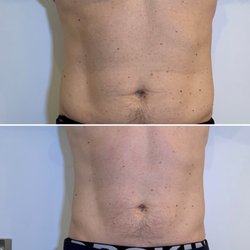 Precision Aesthetics - Emsculpt six pack abs best price sterile luxurious boutique 212 799 1411