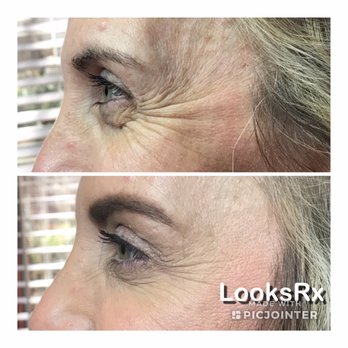 LooksRx - Before and after - Medical Spas Near Me - Garland, Texas LooksRx - Before and after - Medical Spas Near Me - Garland, Texas