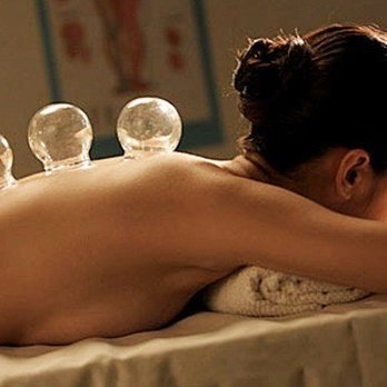 Honeycomb Acupuncture - Cupping often done in conjunction with treatments at Honeycomb Acupuncture. - Acupuncture Near Me - Oakland, California