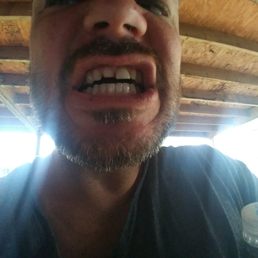 The tooth to your left ... veneer 3 years ago The tooth to your left ... veneer 3 years ago