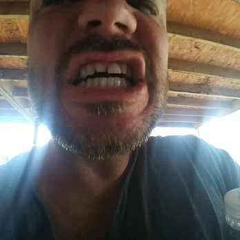 Shine Bright Dentistry - The tooth to your left ... veneer 3 years ago - Cosmetic Dentists Near Me - Bedford, Texas Shine Bright Dentistry - The tooth to your left ... veneer 3 years ago - Cosmetic Dentists Near Me - Bedford, Texas