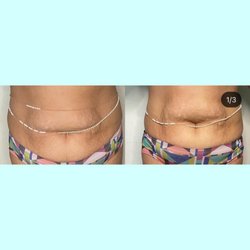 Lenué Sculpting - Non-invasive tummy tuck using Lipo cavitation and radio frequency skin tightening.
