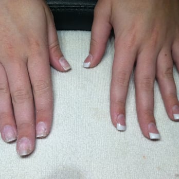 Martie Roark - Before pic. Had to remove thick, layered acrylic completely down to the natural nail. Found glitter and fungus underneath. - Nail Salons Near Me - Thousand Oaks, California Martie Roark - Before pic. Had to remove thick, layered acrylic completely down to the natural nail. Found glitter and fungus underneath. - Nail Salons Near Me - Thousand Oaks, California