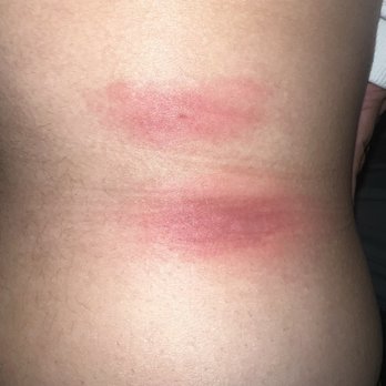 Hampton Inn Denver-Northwest/Westminster - Bed bug bites inflamed - Hotels Near Me - Westminster, Colorado Hampton Inn Denver-Northwest/Westminster - Bed bug bites inflamed - Hotels Near Me - Westminster, Colorado