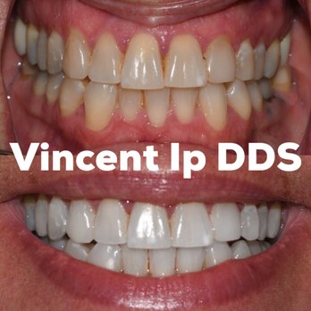 Smile 360 - Before & After Results at SMILE 360 | Austin, TX - General Dentistry Near Me - Austin, Texas