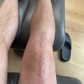 Robert C Klapper, MD - 6 weeks after surgery. Knee feels strong and solid. Thank you Dr. Klapper! - Orthopedists Near Me - Los Angeles, California Robert C Klapper, MD - 6 weeks after surgery. Knee feels strong and solid. Thank you Dr. Klapper! - Orthopedists Near Me - Los Angeles, California