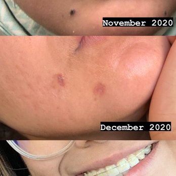 Insight Dermatology - Results of mole removal. - Dermatologists Near Me - San Diego, California Insight Dermatology - Results of mole removal. - Dermatologists Near Me - San Diego, California