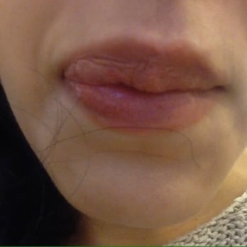 Leslie Gerstman, MD - Juvederm- do not see Dr Gertsman for fillers of any kind - Skin Care Near Me - New York, New York Leslie Gerstman, MD - Juvederm- do not see Dr Gertsman for fillers of any kind - Skin Care Near Me - New York, New York