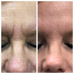Oasis Medaesthetics - Before & After 2 weeks post glabella neurotoxin injections.