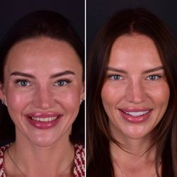 Dr. Michael Y. Jacobson - Robertson Dental Group - Natural looking porcelain veneers