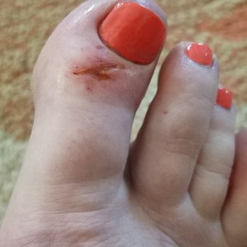 River Nails & Spa - Infected toe from hack job of a pedicure - Nail Salons Near Me - Rocky River, Ohio River Nails & Spa - Infected toe from hack job of a pedicure - Nail Salons Near Me - Rocky River, Ohio
