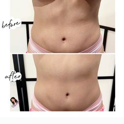 Glam Bodysculpting - Post op care offered too