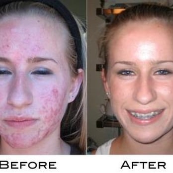 Ray Kidwell, MD - Before and after acne treatment - Dermatologists Near Me - Clovis, California
