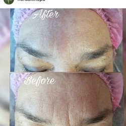 Nora Skin Spa - It is always better to prevent wrinkles rather than fight with them when get deep.