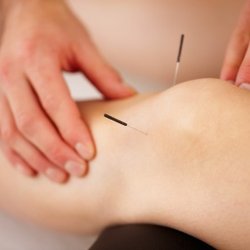 Revivify Acupuncture & Wellness - Acupuncture for knee pain