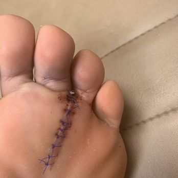 Southwest Foot Institute - At one week post op appt - Podiatrists Near Me - Phoenix, Arizona Southwest Foot Institute - At one week post op appt - Podiatrists Near Me - Phoenix, Arizona