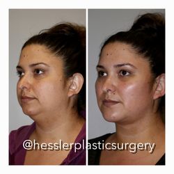 Hessler Plastic Surgery - This patient underwent minimally invasive procedures including buccal fat removal, facetite, ultherapy and fat transfer to the face.