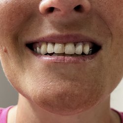 Great Expressions Dental Centers - Stuart - After!!! Amazing! I finally have nice teeth